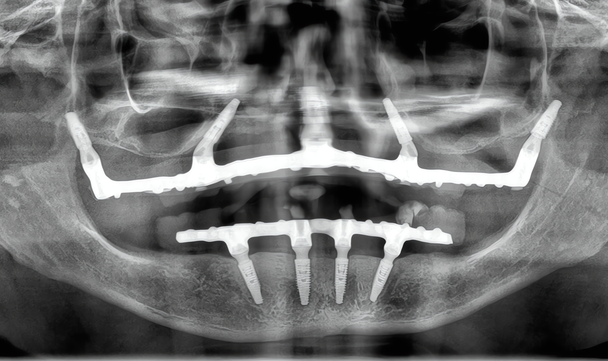 Reconstruções e Implantes